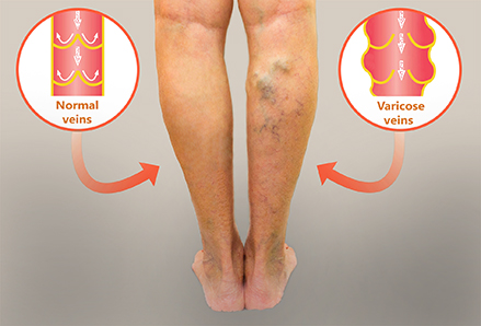 Healthy and Varicose Veins