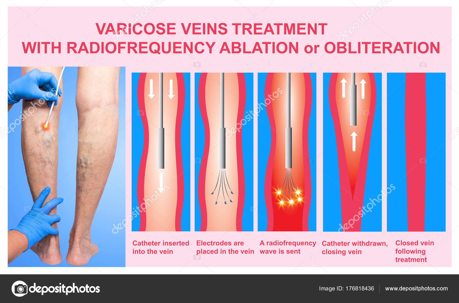 Varicose Veins treatment